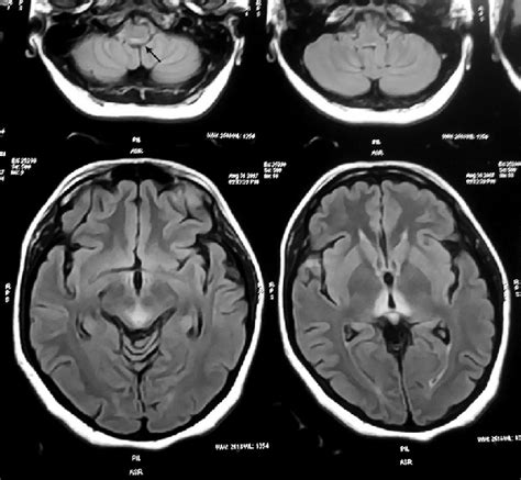 Flair Magnetic Resonance Imaging Brain Showing Bilateral Symmetrical