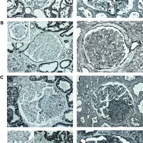 Pdf Necrotic Glomerular Cells Release Histones That Trigger
