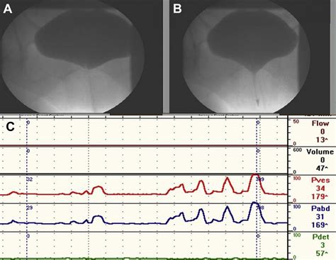 Urodynamics In Stress Incontinence Urologic Clinics