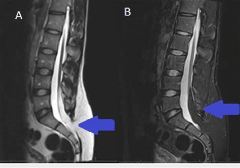 Lumbar Spine Sagittal View Showing Findings Of Tethered Spinal Cord