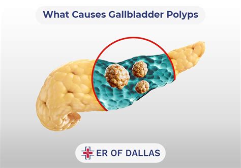 Gallbladder Polyps Symptoms Causes Types And Treatment Er Of Dallas