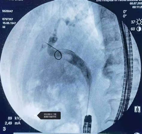 分享一例胃大部切除术后胆总管结石ercp胆胰内镜网