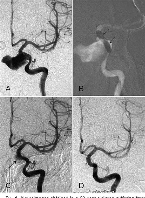 Figure 1 From Reconstructive Endovascular Treatment Of Intracranial