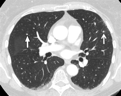 Diffuse Pulmonary Nodules AJR