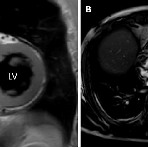 Cardiac Magnetic Resonance Imaging In Different Views Showed Right