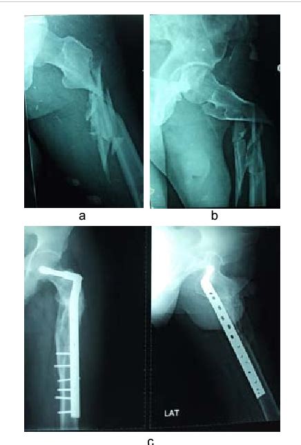 Figure From Management Of Comminuted Subtrochanteric Femur Fractures