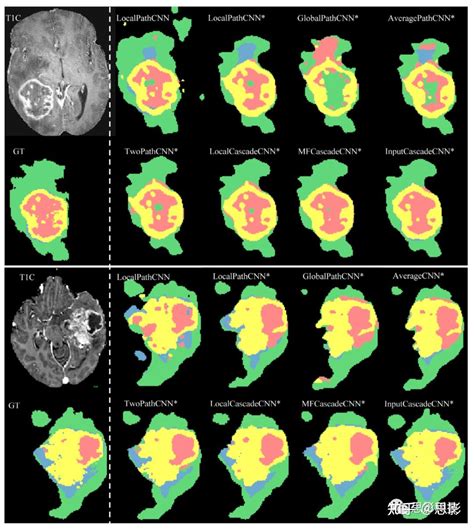 基于神经网络的脑肿瘤分割 知乎
