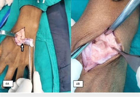 Figure From Bizarre Parosteal Osteochondromatous Proliferation Nora