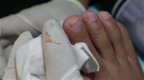 Ep3610 Ingrown Toenail Removal 👣 ดูแล้วเหมือนเข็มไหมค่ะ 😷 Clip From