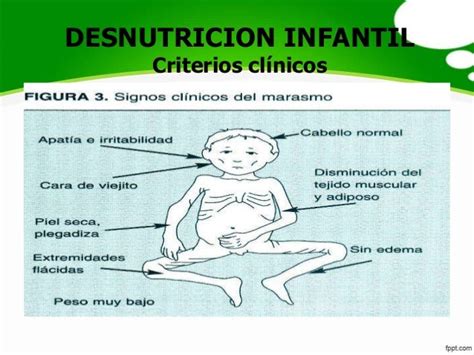 Desnutricion Infantil