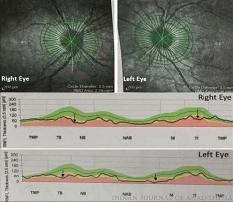 Optical Coherence Tomography Showing A Thinning Of The Inner Retinal