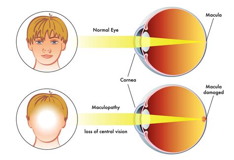 Ocular Disease Detection And Follow Up Whitney Eye Care