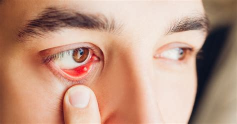 You Asked We Answered Causes Of Eye Styes And How To Treat Nebraska