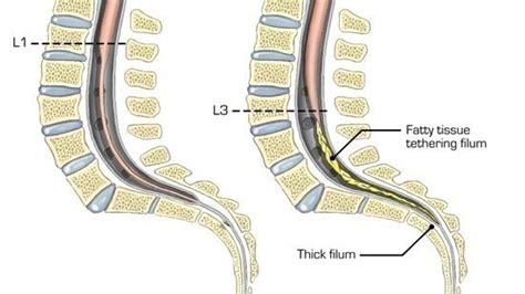 Petition · Sign to Support Funding of Tethered Spinal Cord surgery for ...