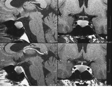 Figure 1 From Clinical Article Vanishing Pituitary Mass Revealed By