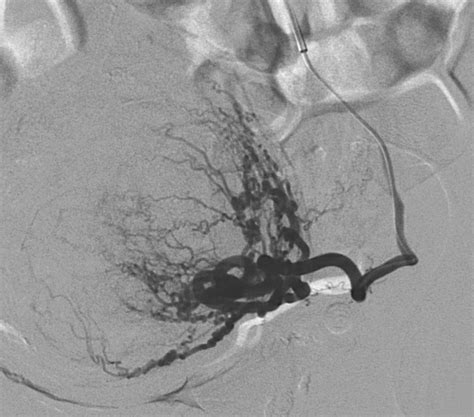 Fibroma Uterino Caso Clinico 9 Interventix