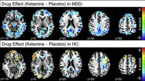 Effects Of Ketamine On Brain Activity During Emotional Processing