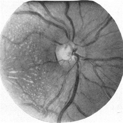 -Case 1. Right eye, showing swollen optic disc with engorgement of... | Download Scientific Diagram