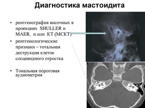 5.-Zabolevaniya-naruzhnogo-ukha_-ostryy-otit_-mastoidit - презентация ...