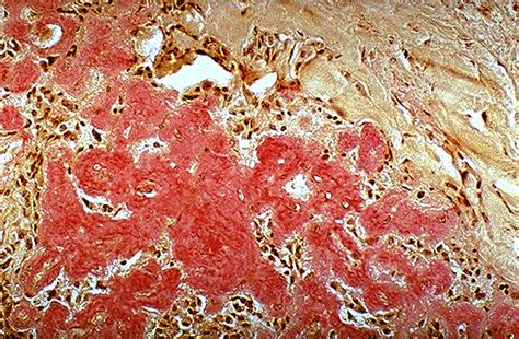 Pathology Outlines Medullary Carcinoma