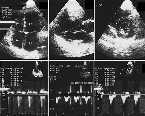 Subvalvular Aortic Stenosis Associated With Valvular Aortic