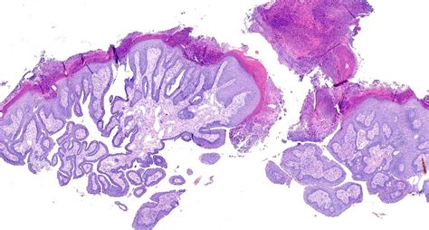 Pathology Outlines Syringocystadenoma Papilliferum