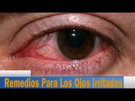 Remedio Casero Para Los Ojos Irritados Cuatro Remedios Caseros Para