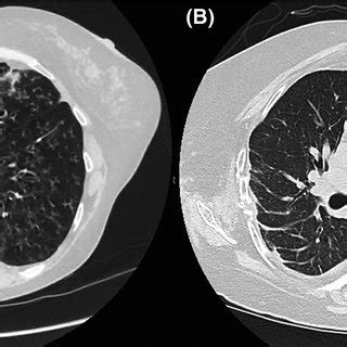 Case 1: Preoperative CT scan (A) showing right lung bronchiectasis and ...