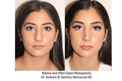 Before And After Rhinoplasty Dr Andrew B Denton Vancouver BC Dr