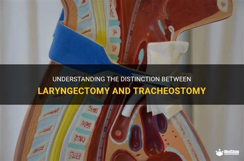 Understanding The Distinction Between Laryngectomy And Tracheostomy Medshun