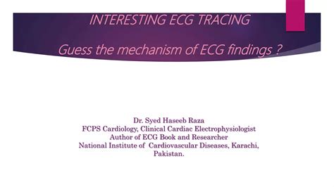 Interesting ecg tracing 1 Alternating Bundle Branch Block | PPT