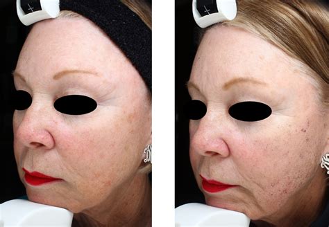 Ipl Skin Rejuvenation Sacramento Ca Emil A Tanghetti Md