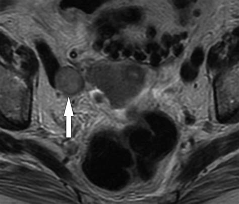 Lymphatic Metastases From Pelvic Tumors Anatomic Classification Characterization And Staging