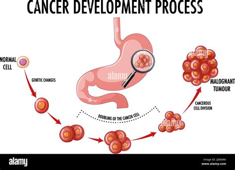 Diagram Showing Cancer Development Process Illustration Stock Vector