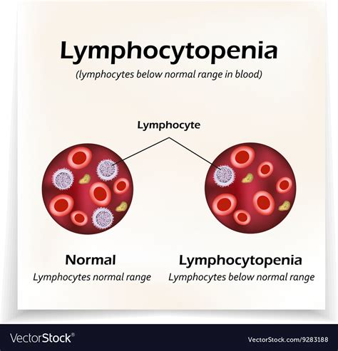 Lymphocytes below normal range in blood Royalty Free Vector