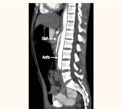 Sagittal Contrast Enhanced Computed Tomography Scan Of The Abdomen Of A