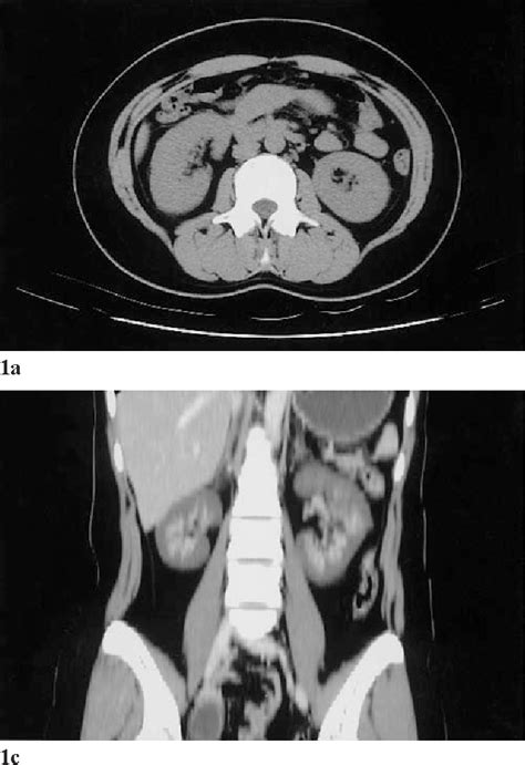 Figure 1 From Ct Findings Of Acute Renal Cortical Necrosis Semantic