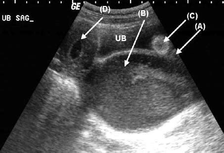 Longitudinal Sonogram Shows The Urethra A Pressed By