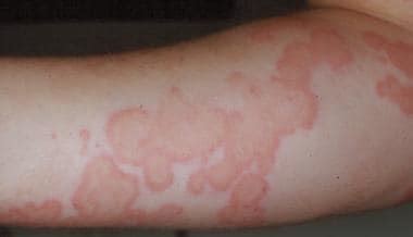 Leukocytoclastic Vasculitis Rash