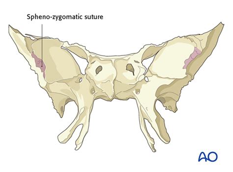 periorbital dissection  lateral orbital wall
