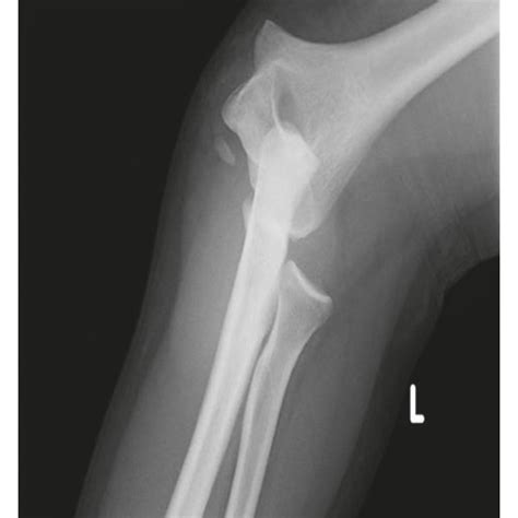 Lateral And Anteroposterior Radiographs Of The Left Elbow Joint 12