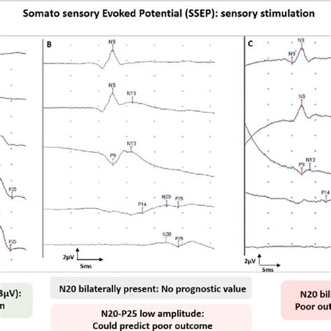 Somato Sensory Evoked Potential Ssep Interpretation And Prognostic