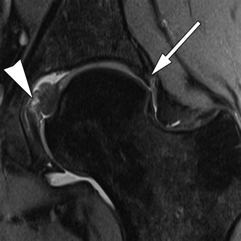 Acetabular Labrum Mri