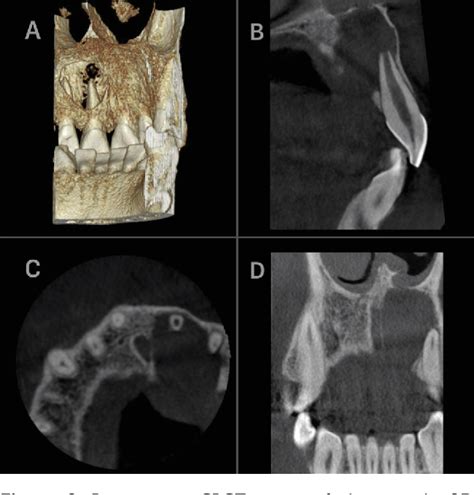 Figure 2 From Management Of Maxillary Radicular Cyst By Using The Titanium Prepared Platelet