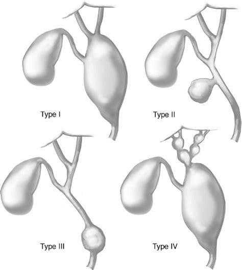 Extrahepatic Bile Duct Anatomy For Types I Iv Choledochal Cyst As Download Scientific Diagram