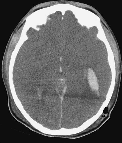 Imaging Assessment Of Penetrating Craniocerebral And Spinal Trauma