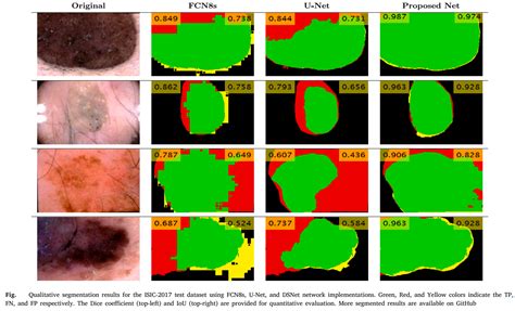 DSNet Automatic Dermoscopic Skin Lesion Segmentation Md Kamrul Hasan