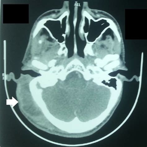 Axial CT Revealed A Huge Subperiosteal Abscess In The Right