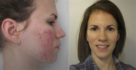 Riversol Md For Rosacea And Sensitive Skin Clarity Medspa