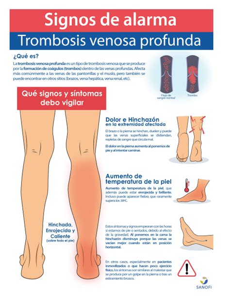 Trombosis Sintomas Conoce Aqui Que Es La Trombosis Venosa Profunda